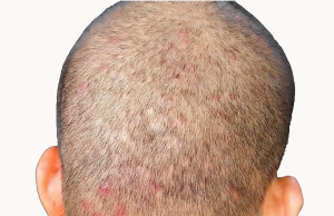 We tried switching shampoos, but this keeps flaring up on my son’s scalp. What else helps scalp breakouts?